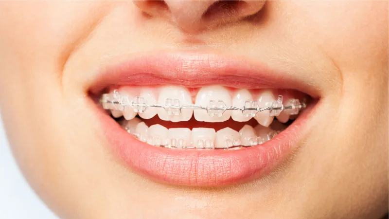 Detalle de una sonrisa estética