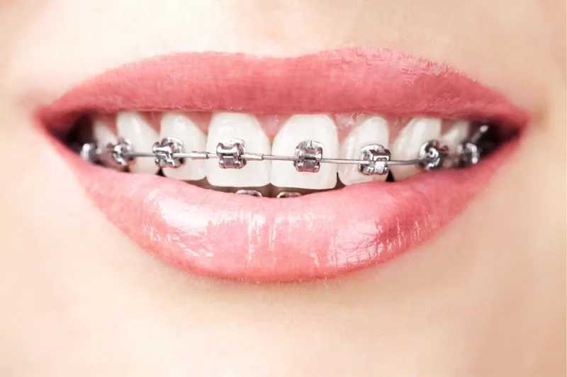Detalle de brackets metálicos