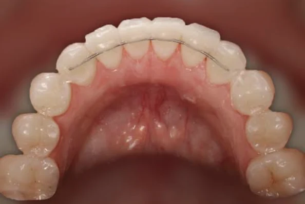 Retenedor lingual fijo 3x3 adherido detrás de los dientes anteriores